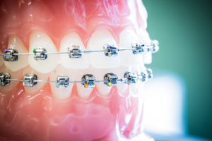 Damon-Clear-Invisalign-Nudera-Orthodontics-Braces-in-Chicagoland-7-300x200  - Braces and Invisalign in South Elgin and Elmwood Park, IL - Nudera Orthodontics