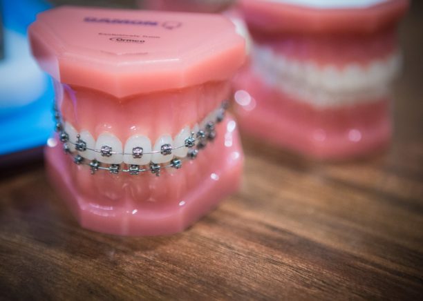 Nudera-Orthodontics-Braces-and-appliances-in-Chicagoland-3-612x436  - Braces and Invisalign in South Elgin and Elmwood Park, IL - Nudera Orthodontics