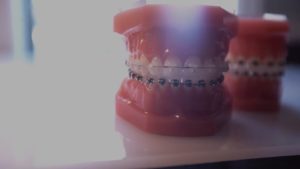 clear-header-thumb-300x169  - Braces and Invisalign in South Elgin and Elmwood Park, IL - Nudera Orthodontics